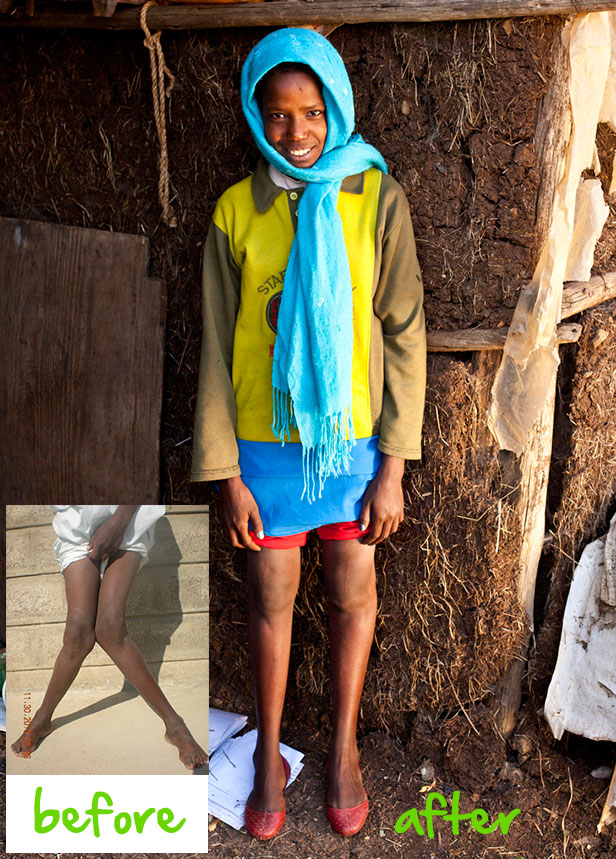 Abaynesh, before and after treatment at CURE Ethiopia