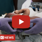 BBC News Features CURE Uganda’s Shuntless Solution for Hydrocephalus
